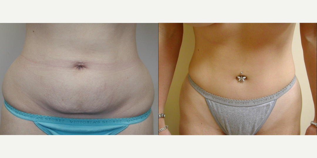Tummy Tuck (Abdominoplasty) procedure image