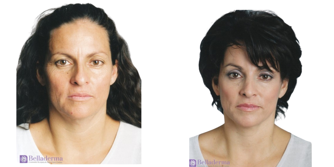 Eyelid Surgery (Blepharoplasty) procedure image
