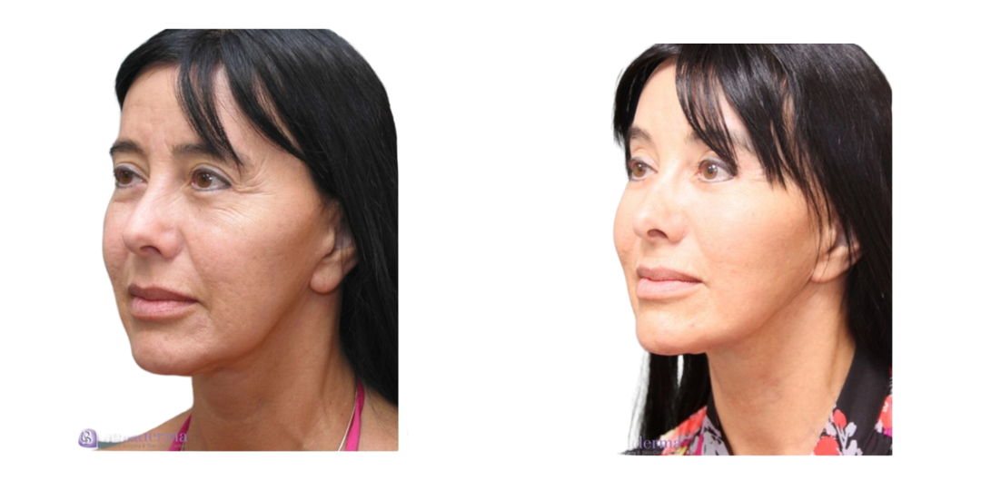 Facelift procedure image