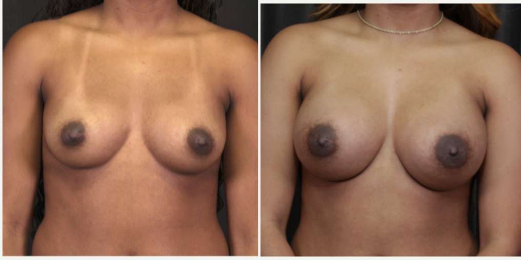 Breast Augmentation procedure image