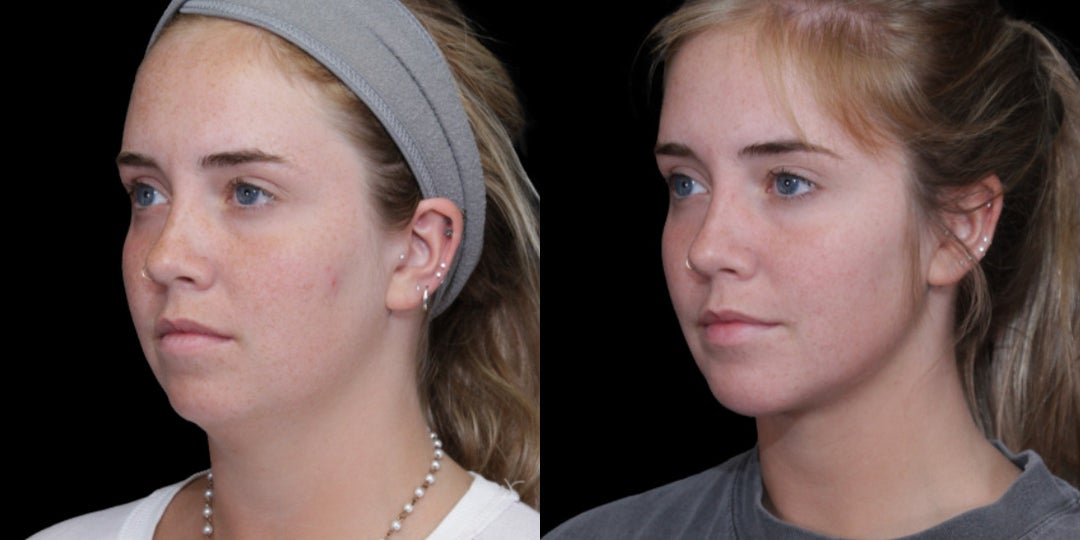 Chin Implant procedure image