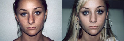 Rhinoplasty (Nose Job) procedure image