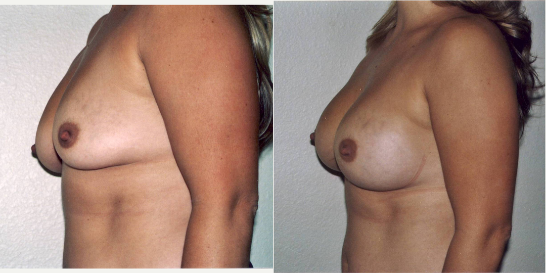 Mommy Makeover procedure image