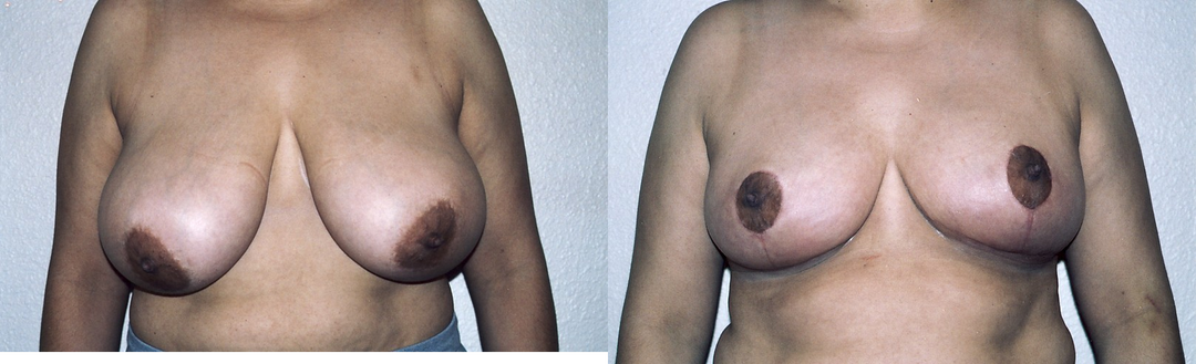 Breast Augmentation procedure image