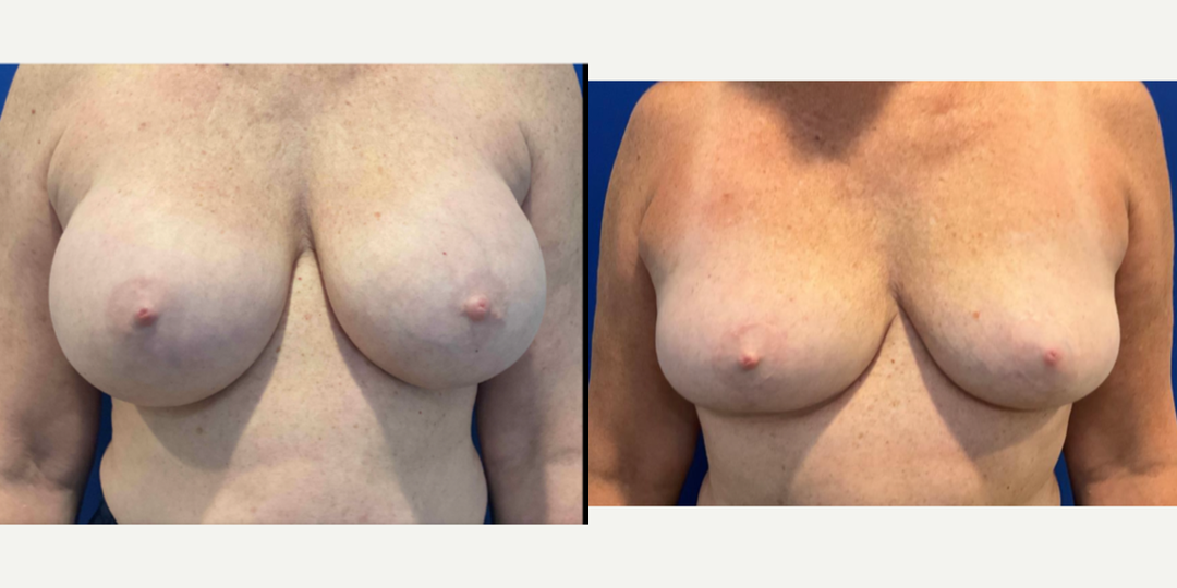 Breast Augmentation procedure image