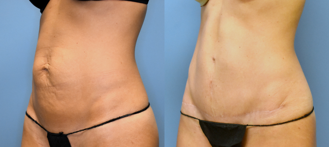 Tummy Tuck (Abdominoplasty) procedure image