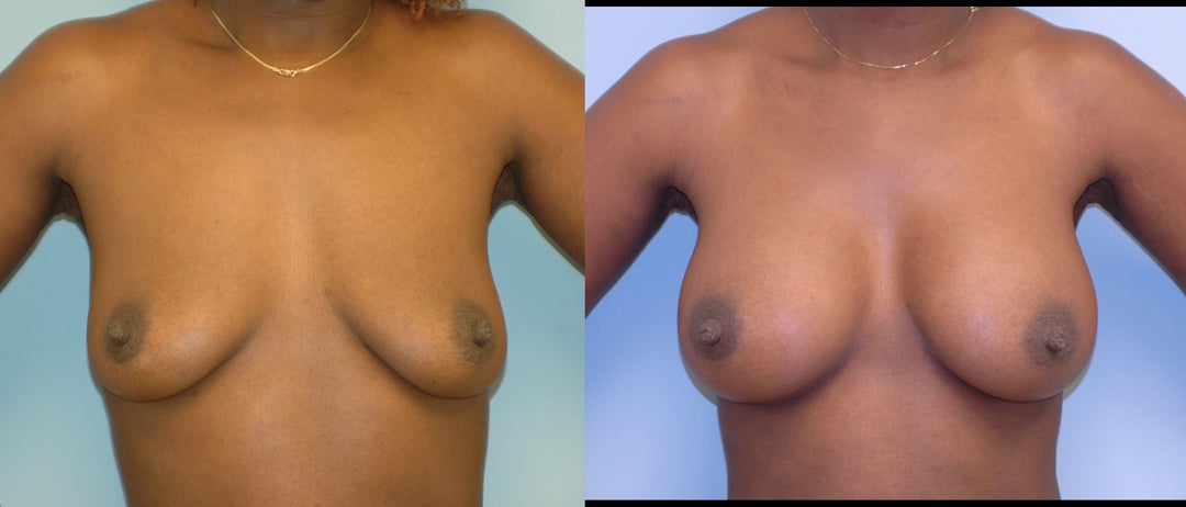 Breast Augmentation procedure image
