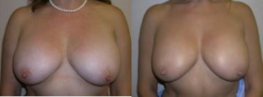 Breast Augmentation procedure image