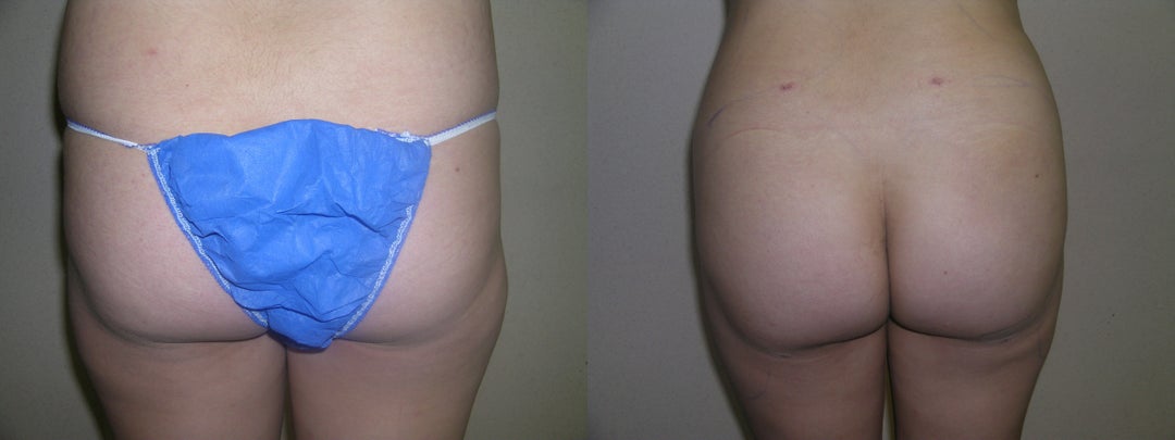 Brazilian Butt Lift (BBL) procedure image