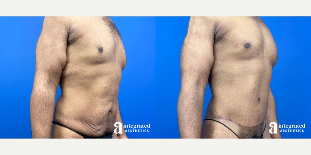 Skin Tightening procedure image