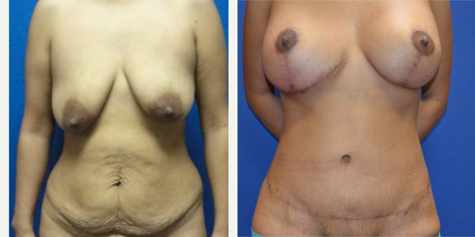 Breast Augmentation procedure image