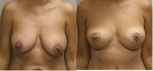 Mommy Makeover procedure image