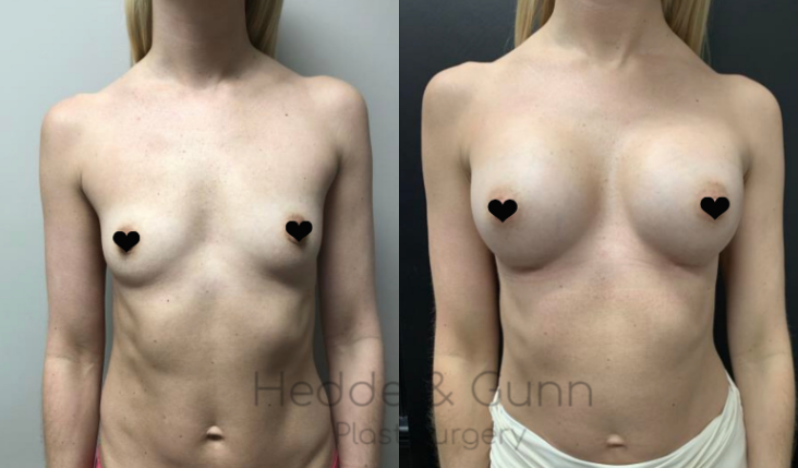 Breast Augmentation procedure image