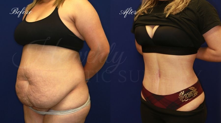 Tummy Tuck (Abdominoplasty) procedure image