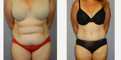 Tummy Tuck (Abdominoplasty) procedure image