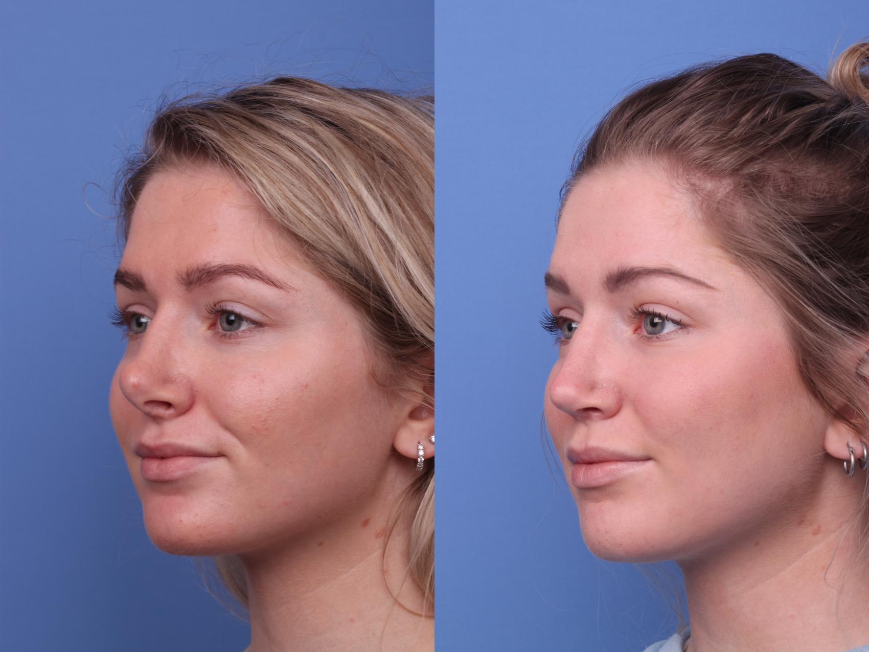 Rhinoplasty (Nose Job) procedure image