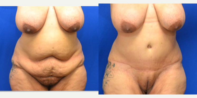 Mommy Makeover procedure image