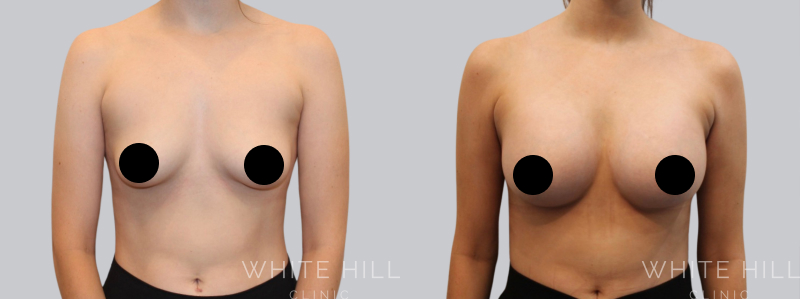 Breast Augmentation procedure image