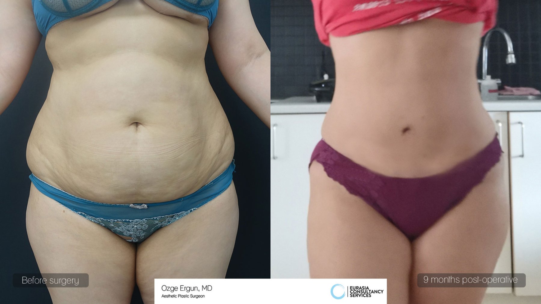 Tummy Tuck (Abdominoplasty) procedure image