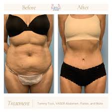 Tummy Tuck (Abdominoplasty) procedure image