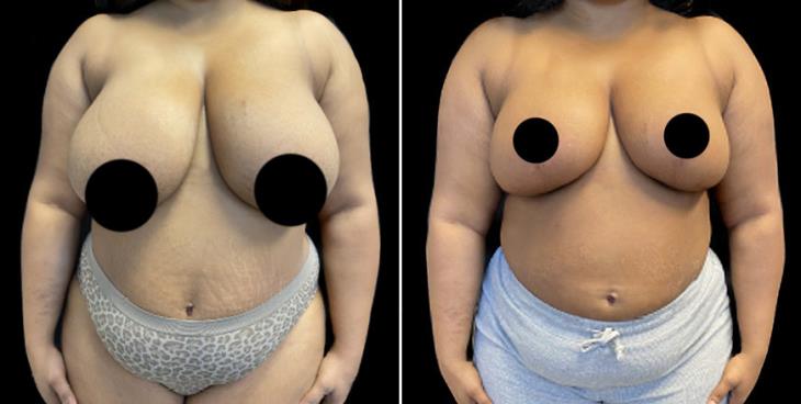 Breast Augmentation procedure image