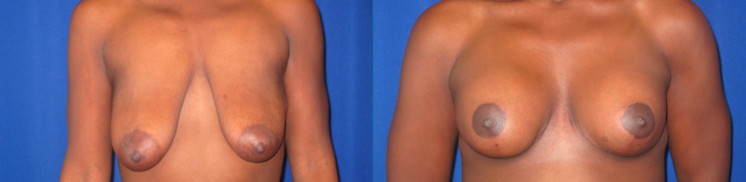 Breast Augmentation procedure image