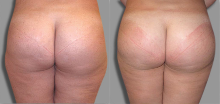 Brazilian Butt Lift (BBL) procedure image