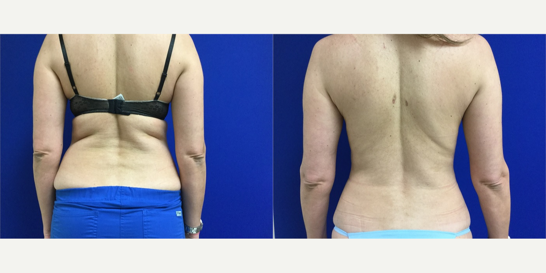 Lipo 360 procedure image