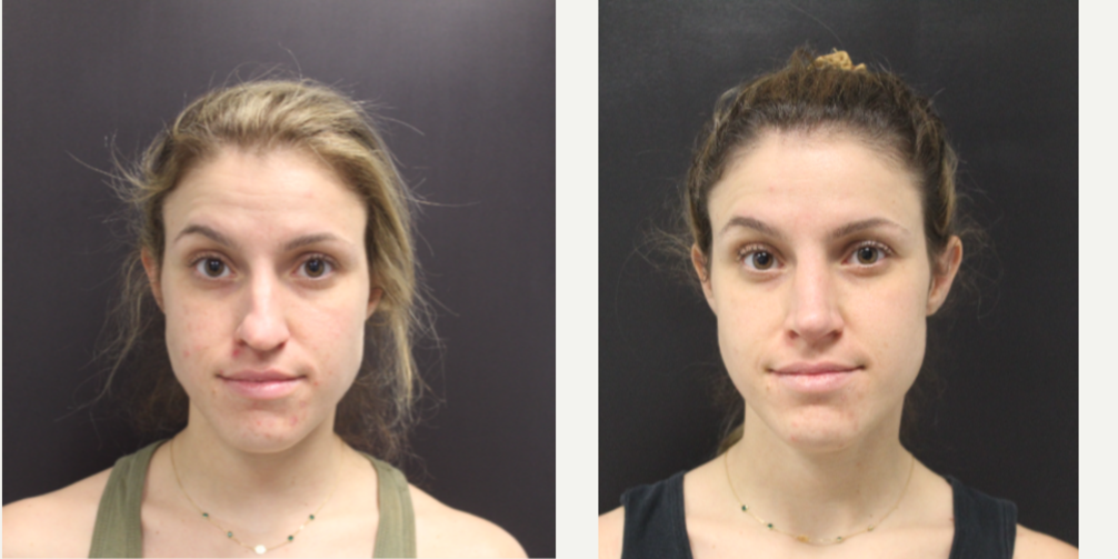 Rhinoplasty (Nose Job) procedure image