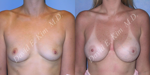 Breast Augmentation procedure image