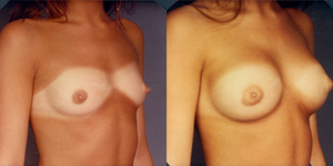 Mommy Makeover procedure image