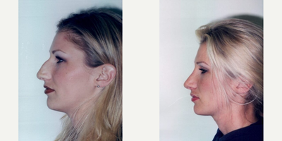 Rhinoplasty (Nose Job) procedure image