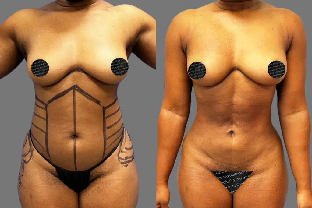 Breast Augmentation procedure image