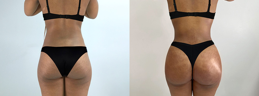 Brazilian Butt Lift (BBL) procedure image