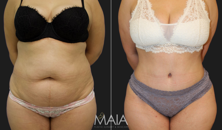 Tummy Tuck (Abdominoplasty) procedure image
