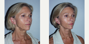 Facelift procedure image