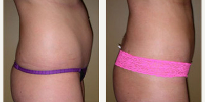 Liposuction procedure image