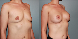 Mommy Makeover procedure image