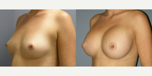 Breast Augmentation procedure image