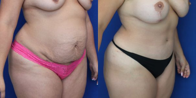 Mommy Makeover procedure image