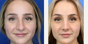 Rhinoplasty (Nose Job) procedure image