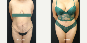 Mommy Makeover procedure image