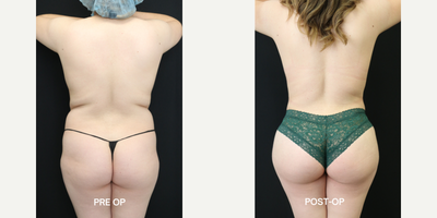 Brazilian Butt Lift (BBL) procedure image