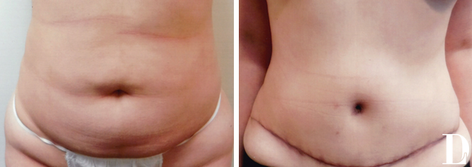 Tummy Tuck (Abdominoplasty) procedure image