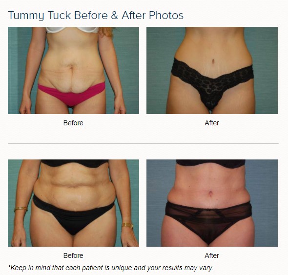 Mommy Makeover procedure image