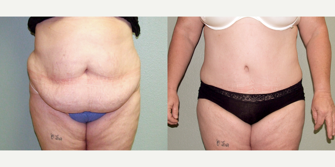 Tummy Tuck (Abdominoplasty) procedure image