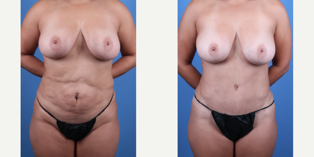 Tummy Tuck (Abdominoplasty) procedure image