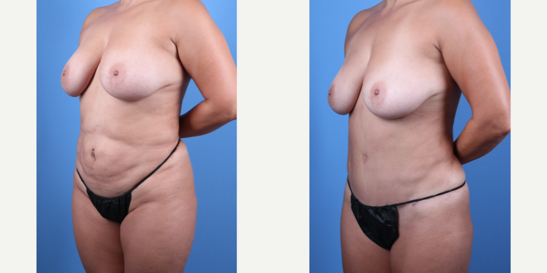 Breast Augmentation procedure image