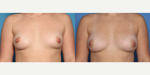 Mommy Makeover procedure image