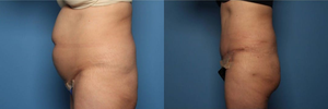 Tummy Tuck (Abdominoplasty) procedure image